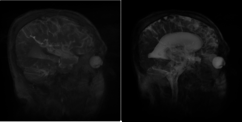 Ventricles_Basic_Boundary.png