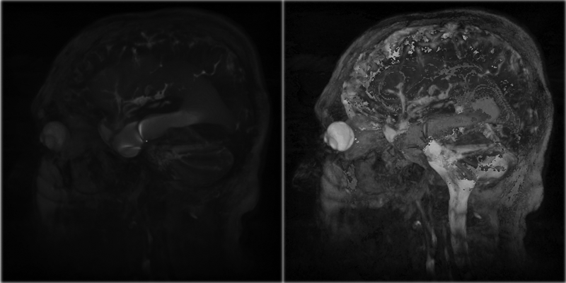 Ventricles_Basic_Projection.png